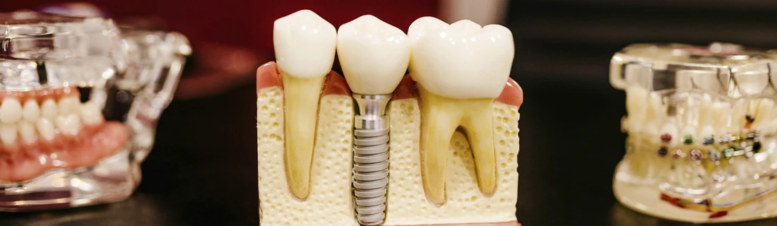 FC- Dental Implants at Fall Creek Family Dental in Indianapolis IN