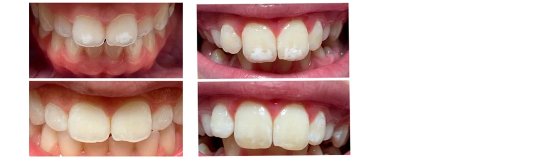 Four close-up photos of front teeth showing different tooth shapes, alignment, and surface appearance.
