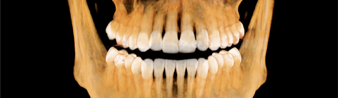 Panoramic 3D dental imaging showing upper and lower teeth, roots, and jawbones on a black background.